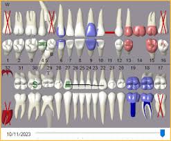 open dental graphical tooth