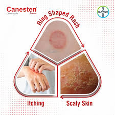 canesten cream 30gm at upto