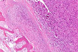 Inexpensive procedure shows whether patient has cancerous cells in the body, but does not reveal where or how serious it is. Osteosarcoma Wikipedia