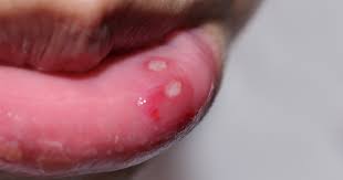 mouth ulcers causes of mouth ulcers
