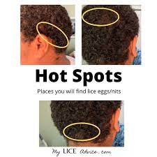 Can a black person have lice. Black Children Get Lice Too Unique Challenges And Treatments