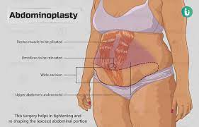 Abdominoplasty: Procedure, Purpose, Results, Cost, Price