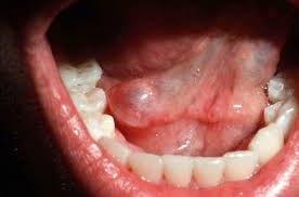mucous cyst mouth or mucous retention
