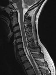 Syrinx Syringomyelia Spine Orthobullets