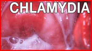 Infection à chlamydia : ce qu'il faut savoir - Votre Santé
