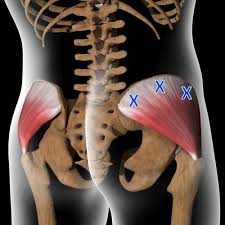 myofascial trigger points lumbar and