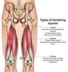 hamstring strains and hamstring syndrome