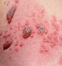 skin infections illinois dermatology