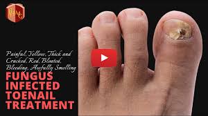 toenail fungus dermatology