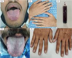 peripheral fingernails cyanosis