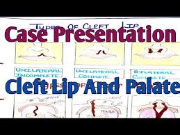 cleft lip and cleft palate lesson plan