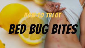 how to treat bed bug bites the