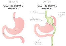 consent gastric byp teachmesurgery