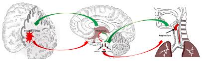 insular cortex on post stroke dysphagia