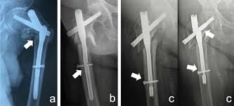 pertrochanteric femur fractures