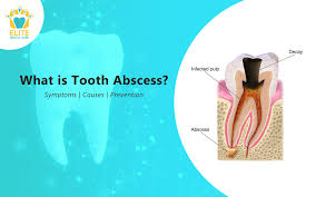 tooth abscess symptoms causes