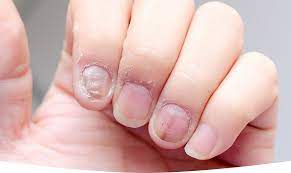 nail fungal treatment in singapore dr