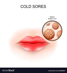 cold sores in the lip fever blisters