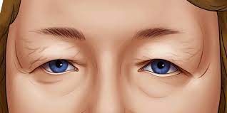 how to qualify for eyelid surgery cost