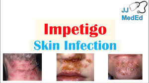 impetigo infection subtypes