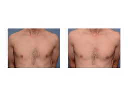 Poland syndrome is sometimes difficult to diagnose, especially in mild cases. Plastic Surgery Case Study Custom Pectoral Implant In Poland S Syndrome Explore Plastic Surgery