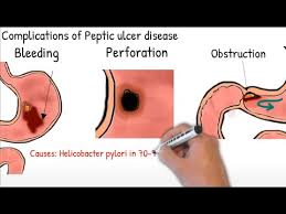 gastric ulcer and duodenal ulcer in 2