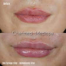 tell me more about lip filler charmed