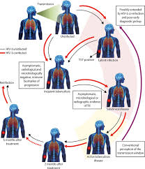 Tuberculosis generally affects the lungs, but can also affect other parts of the body. Advances In The Understanding Of Mycobacterium Tuberculosis Transmission In Hiv Endemic Settings The Lancet Infectious Diseases