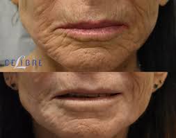 botox for smokers lines before and