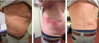 When a roof needs replacement, one of your first questions will involve cost. 20 Post Covid 19 Vaccine Related Shingles Cases Seen At The Las Vegas Dermatology Clinic And Sent To Us Via Social Media Lee 2021 Journal Of Cosmetic Dermatology Wiley Online Library