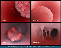 It is a condition where patches of endometrium grow outside the uterus commonly in the abdomen or lower abdomen. Adhesions Dr Seckin