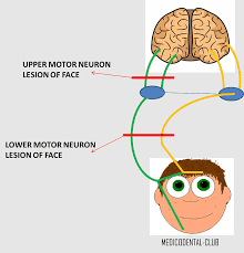 lower motor neuron lesion upper motor