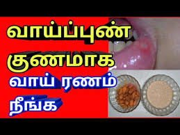 mouth ulcer home remes