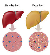Home Remedies For Fatty Liver Natural Treatment