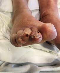 black spots on toes 7 causes