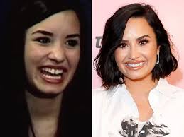 In most cases, your orthodontist will manage the situation on his own. Celebrities Who Have Closed Their Gap Teeth