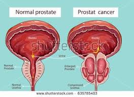 Although screenings for prostate cancer are one tool for early detecti. Pin On Tezi Dume Ni Ugonjwa Mbaya Sana Kwako Mwanaume