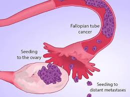 We did not find results for: Many Ovarian Cancers May Start In Fallopian Tubes National Cancer Institute