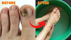 natural cure for toenail fungus