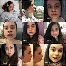 double jaw surgery the recovery