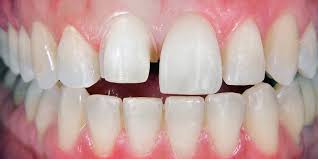 You then wear the bands as needed in order to keep the gap closed. Know The Teeth Gap Treatment Cost And Methods In Markham