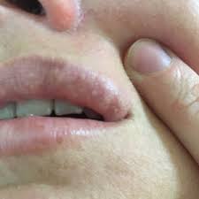inner lip 4 days after filler