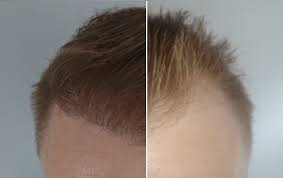 I still have redness on front with a few growth. Fue Hair Transplant From Day 1 To 12 Months Hair Transplant Story