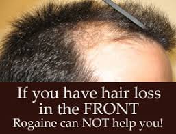 rogaine treat receding hairline