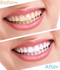 whiten teeth with baking soda and