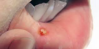 Auch am gaumen können sich die kleinen geschwüre entwickeln. Aphten Schmerzhafte Blaschen Im Mund