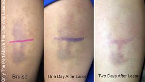 laser that gets rid of bruises