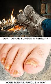 friggin foot fungus prevention and
