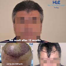 Poor growth after hair transplants: Hair Transplant Of The Receding Hairline Hairforlife