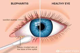 blepharitis eyelid inflammation